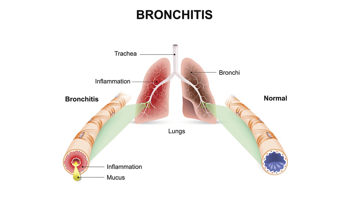 This image depicts the difference between a healthy lung air passage and an unhealthy lung air passage.