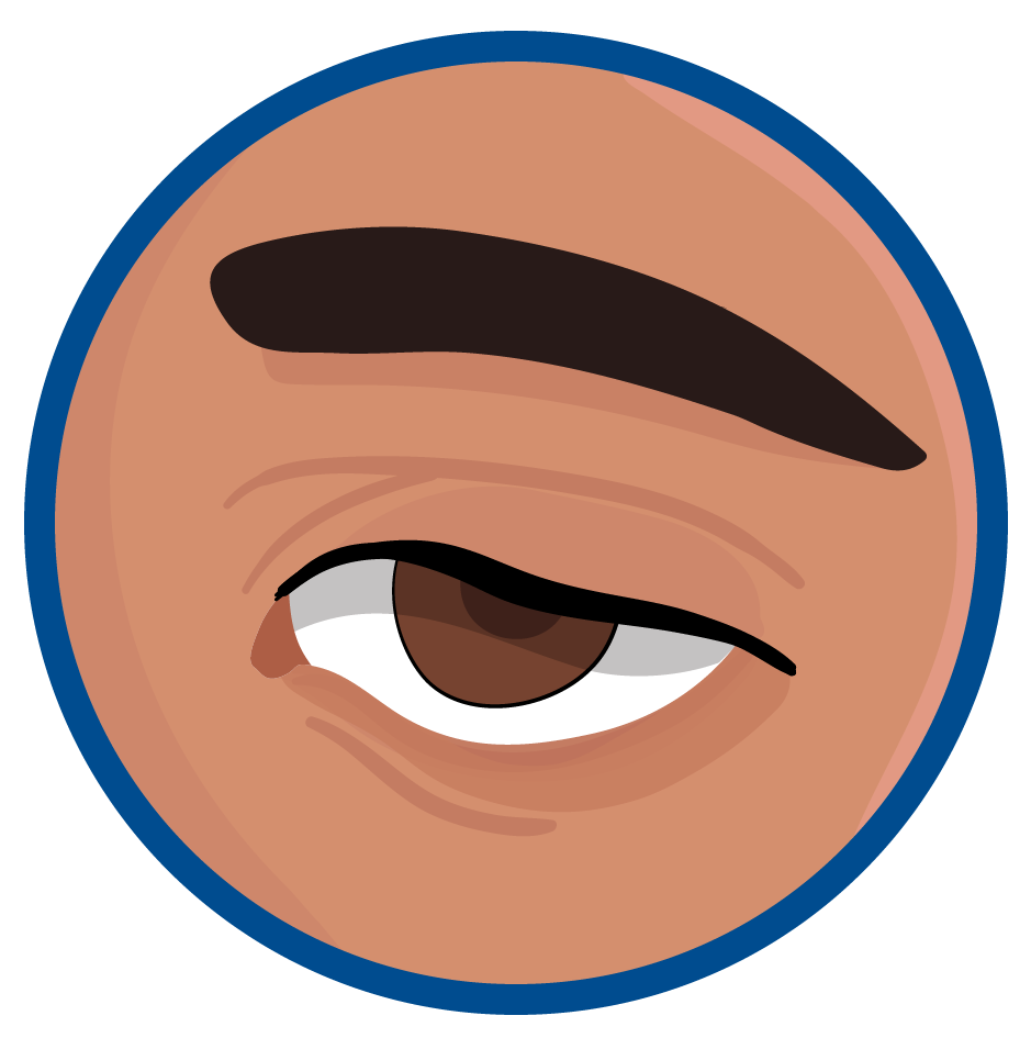 Síntomas de la MFA: dificultad para mover los ojos o párpados caídos.