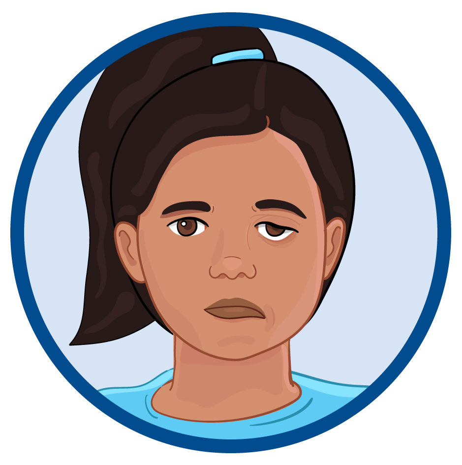 Síntomas de la MFA: debilidad o flacidez en la cara