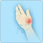 Illustration of anthrax spores getting into a cut on the skin, causing cutaneous anthrax where it enters