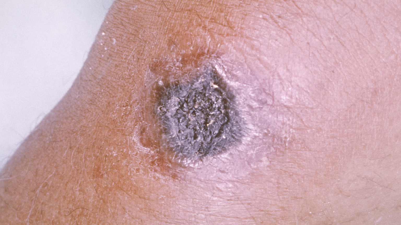 a cutaneous anthrax sore on a person's arm
