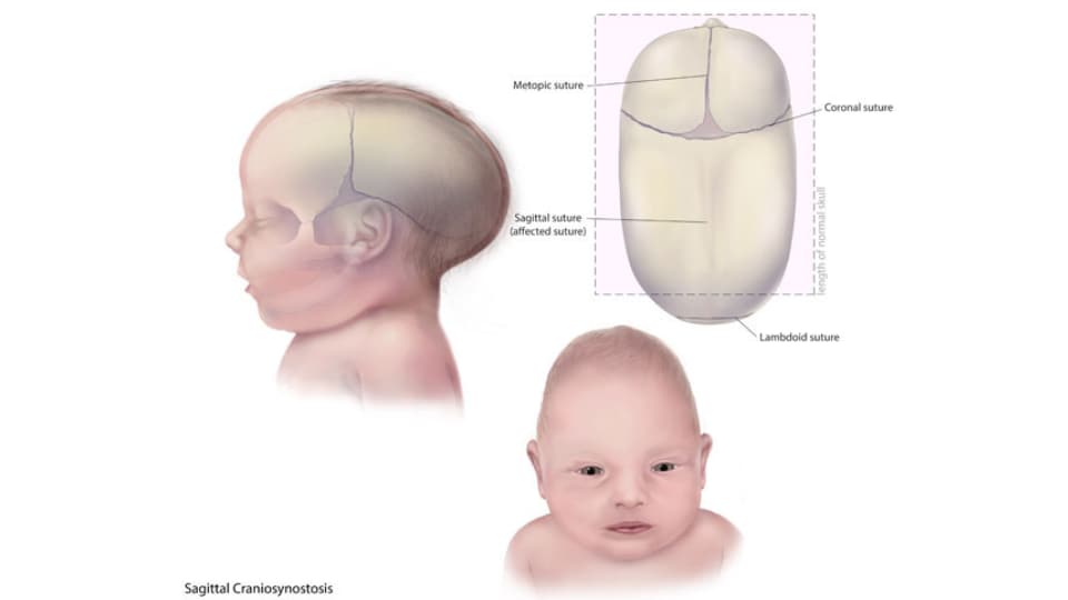 Illustration of an infant with Sagittal Craniosynostosis.