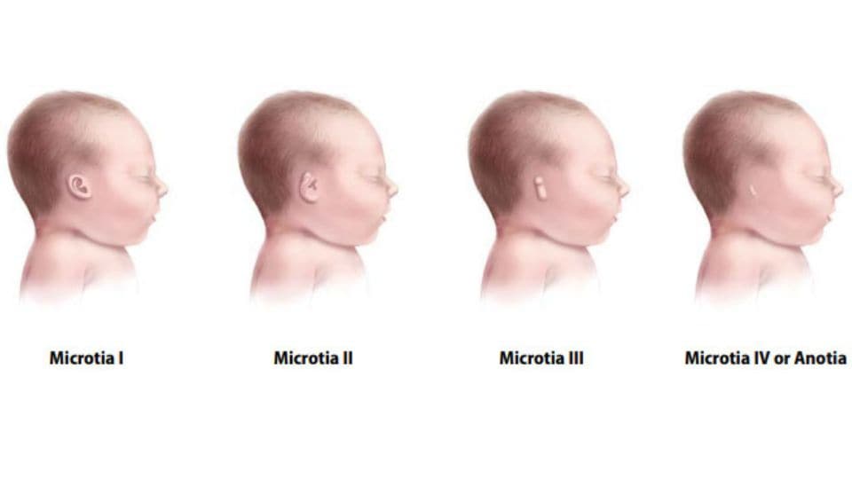 Illustration of the range of severity for microtia/anotia, from baby with small external ear to no visible external ear.