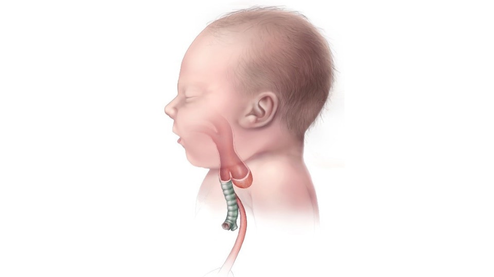 Illustration of infant with esophageal atresia type C.