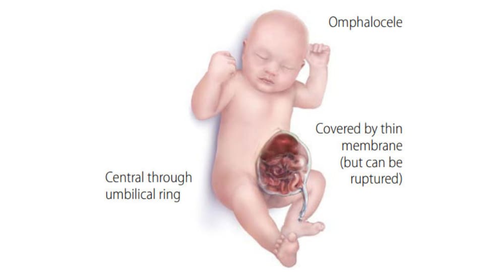 Illustration of infant with omphalocele. Text on the graphic reads omphalocele, central through the umbilical cord, covered by a think membrane (but can be ruptured).