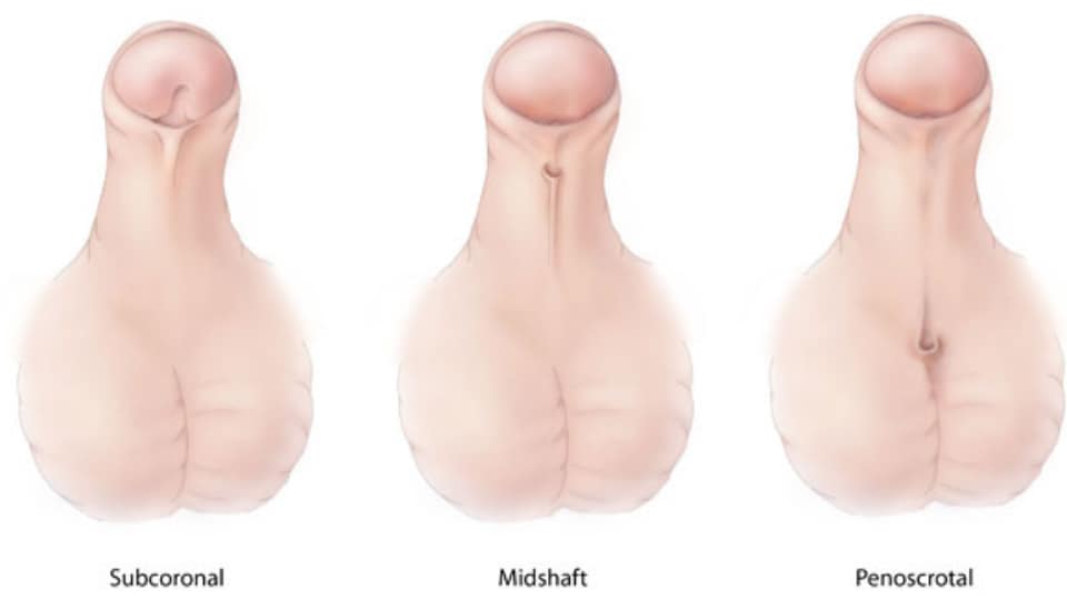 Medical illustration of hypospadias showing the 3 types, Subcoronal (opening of the urethra is located near the head of the penis), Midshaft (opening of the urethra is located along the shaft of the penis), Penoscrotal ( opening of the urethra is located where the penis and scrotum meet).