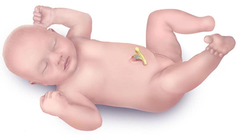 Illustration of a newborn with congenital absence of one foot.