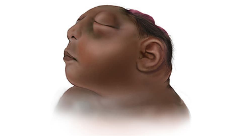 Illustration of infant with anencephaly, missing portions of brain and skull.