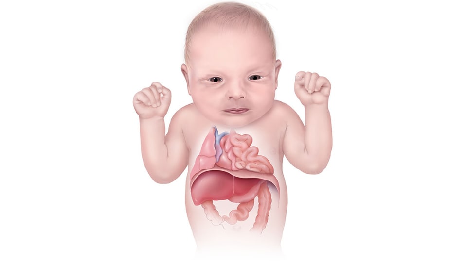 Illustration of infant showing internal organs. Infant has diaphragmatic hernia, and abdominal organs are in chest.