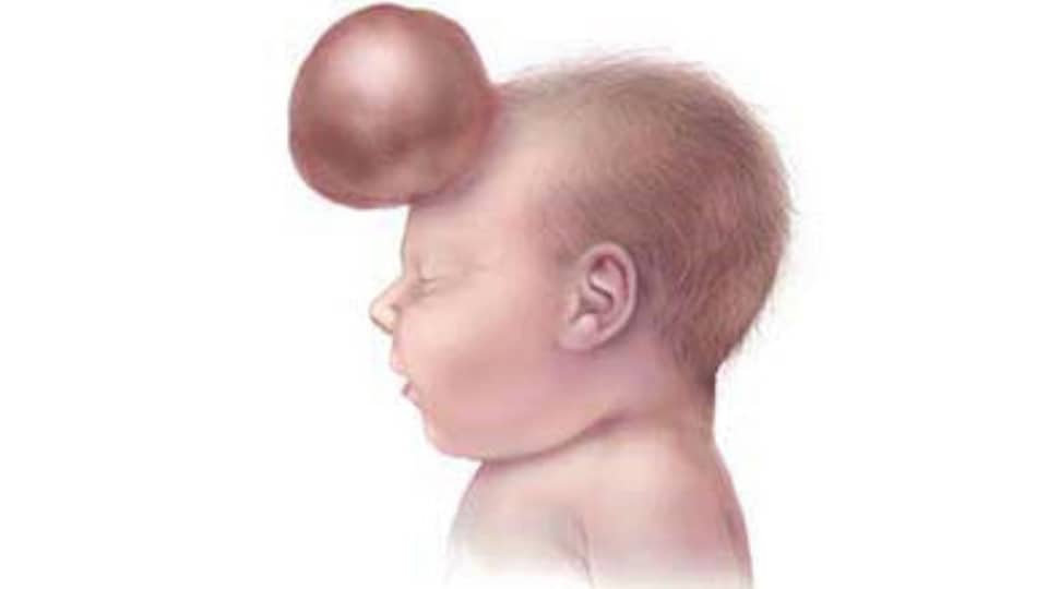 Illustration of infant with a frontal encephalocele, protrusion on forehead.