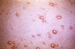 shingles This photograph depicted a close view of a patient’s skin surface, revealing the presence of a pustular-vesicular rash, which was attributed to a generalized herpes zoster outbreak, due to the varicella-zoster virus (VZV) pathogen.