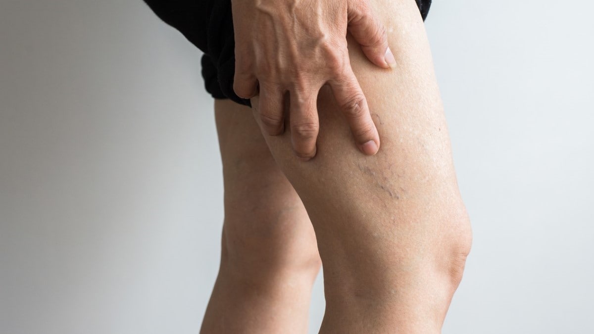 Blood clots a person with a blood clot in the leg