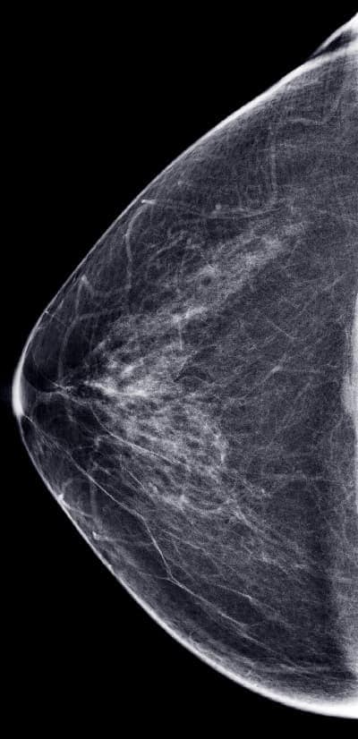 Digital mammogram