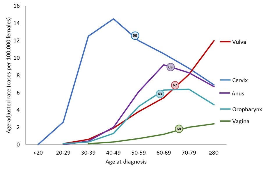 Line chart showing the median age at diagnosis for HPV-associated cancers among women. 50 years for HPV-associated cervical cancer, 68 for HPV-associated vaginal cancer, 67 for HPV-associated vulvar cancer, 63 for HPV-associated anal cancer, and 63 for HPV-associated oropharyngeal cancers.