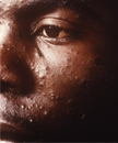Chickenpox in unvaccinated adult