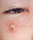 people_varicella.jpg This is an image of a girl with a secondary skin infection on her face due to chickenpox.