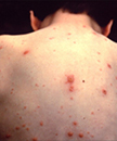people_varicella2.jpg This child presented with the characteristic pancorporeal varicella, or chickenpox lesions.