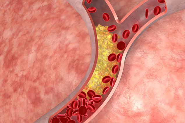 Learn About Cholesterol Cholesterol in the arteries.