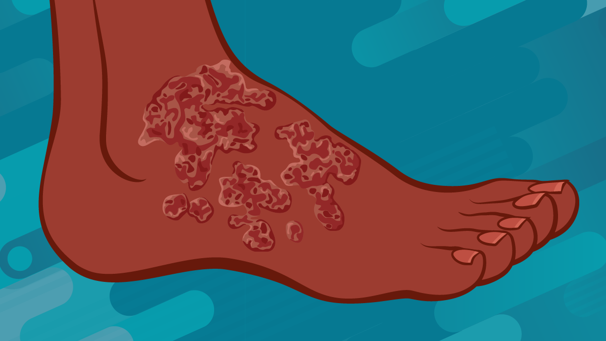 Use this to show what chromoblastomycosis looks like. An illustration of a foot showing chromoblastomycosis