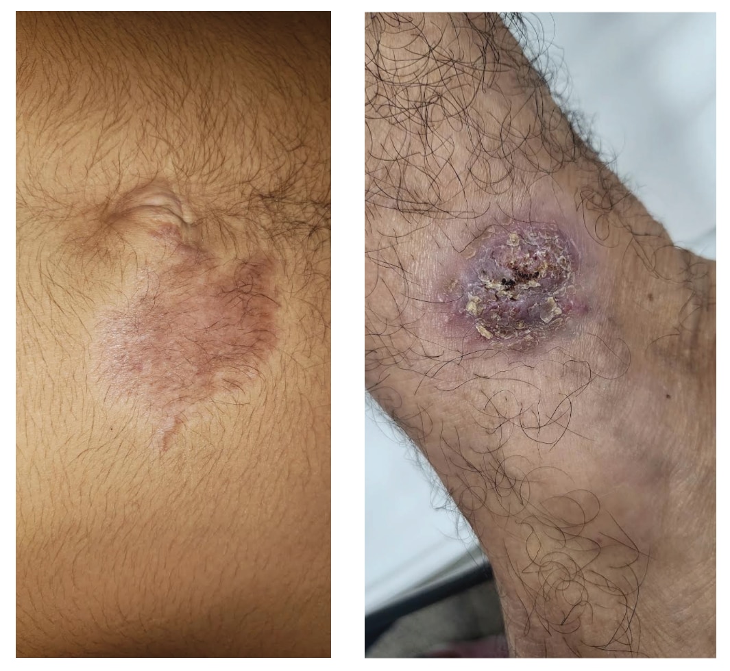Early and late stage of chromoblastomycosis infection. Photo credit to “Conceicão de Maria Pedrozo e Silva de Azevedo from Universidade Federal do Maranhão, Maranhão, Brazil” Early and late stage of chromoblastomycosis infection.