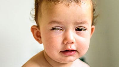 Baby showing symptoms; crusting of her eyelids