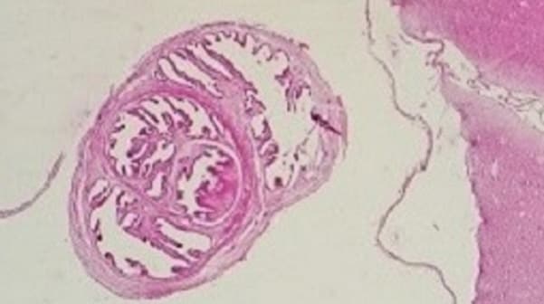 home_page_image_cysticercosis cysticercosis