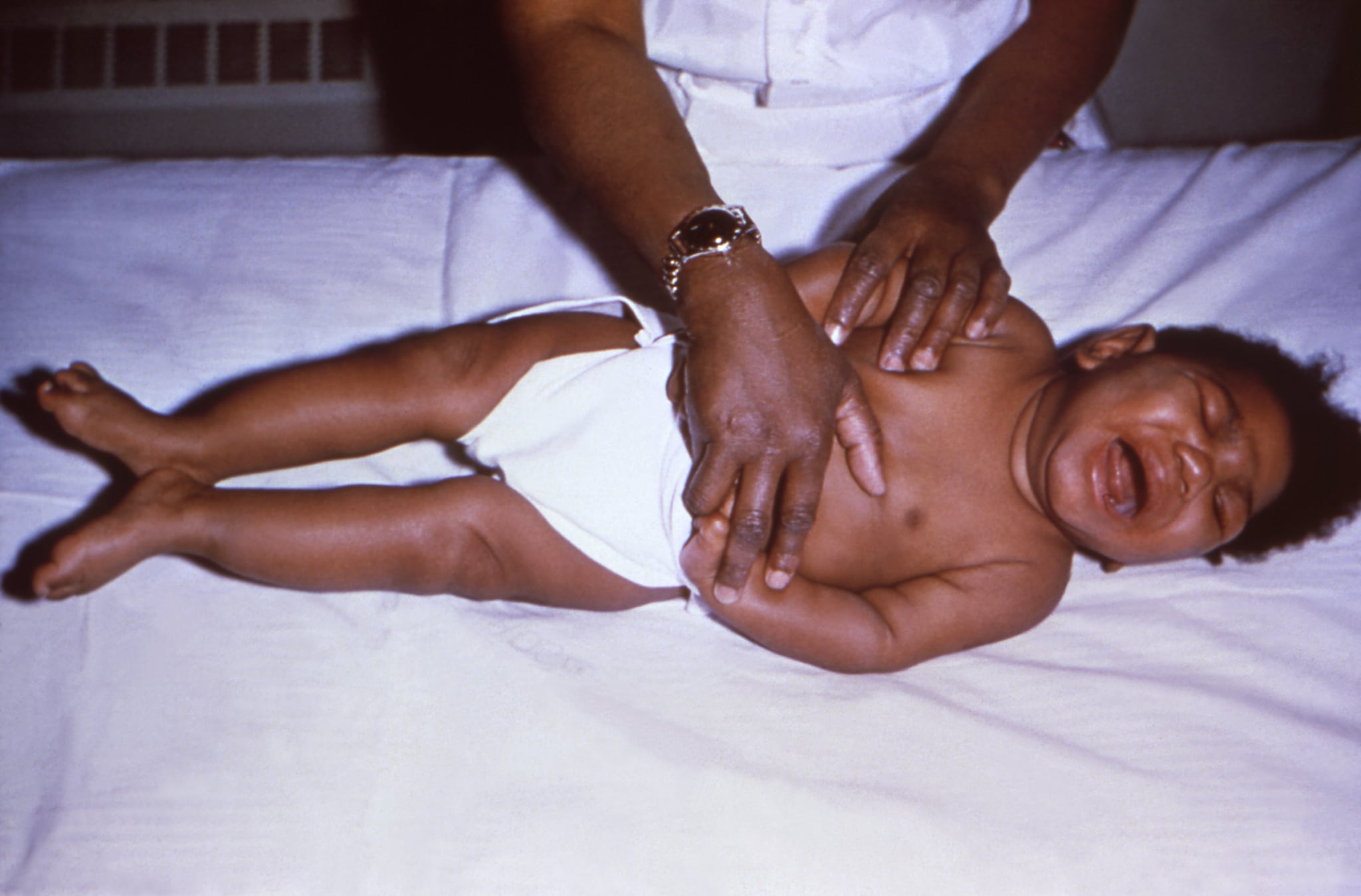 — title missing — Infant born with congenital CMV showing signs of severe microcephaly and lower limb spasticity. Source: CDC Public Health Image Library.