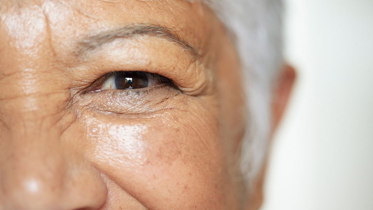 diabetes-vision-loss Closeup of a senior woman’s eye