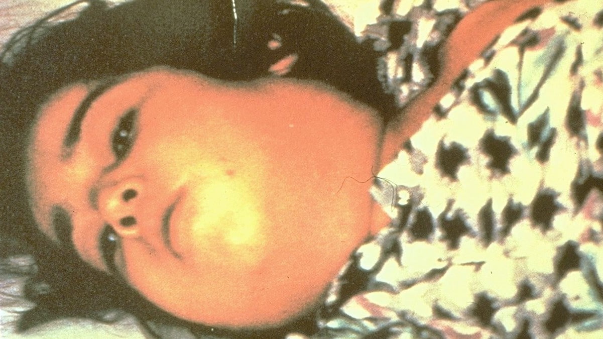 Diphtheria bull neck Child with cervical swelling, referred to as bull neck, which is a symptom of diphtheria.