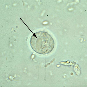 E_histodispar_2x2_A.jpg Figure A: Cyst of <em>E. histolytica/E. dispar</em> in an unstained concentrated wet mount of stool. Notice the chromatoid bodies with blunt, rounded ends (arrow).