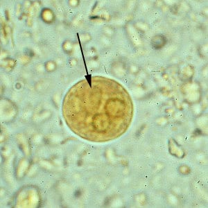 E_histodispar_2x2_C.jpg Figure D: Cyst of <em>E. histolytica/E. dispar</em> in a concentrated wet mount stained with iodine. Notice the chromatoid body with blunt, rounded ends (arrow).
