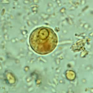 Ehistdisp_cyst_wtmt.jpg Figure C: Cyst of <em>E. histolytica/E. dispar</em> in a concentrated wet mount stained with iodine.