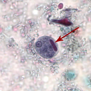 Ehistdisp_cyst_tric.jpg Figure A: Cyst of <em>E. histolytica/E. dispar</em> stained with trichrome. Note the chromatoid body with blunt ends (red arrow).