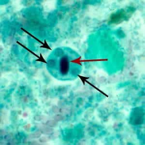 Ehistdisp_cyst_tric2.jpg Figure C: Cyst of <em>E. histolytica/E. dispar</em> stained with trichrome. Three nuclei are visible in the focal plane (black arrows), and the cyst contains a chromatoid body with typically blunted ends (red arrow). The chromatoid body in this image is particularly well demonstrated.