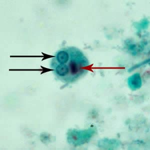 Ehistdisp_cyst_tric3.jpg Figure D: Cyst of <em>E. histolytica/E. dispar</em> stained with trichrome. Two nuclei are visible in the focal plane (black arrows), and the cyst contains a chromatoid body with typically blunted ends (red arrow).