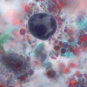 Ehistdisp_cyst_tric5_KS.jpg Figure B: Immature cyst of <em>E. histolytica/E. dispar</em> stained with trichrome. Image taken at 1000x oil magnification and contributed by the Kansas Department of Health and Environment.