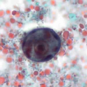 Ehistdisp_cyst_tric6_KS.jpg Figure C: Immature cyst of <em>E. histolytica/E. dispar</em> stained with trichrome. The cyst has large vacuoles and the chromatin around the nucleus is clumpy. Image taken at 1000x oil magnification and contributed by the Kansas Department of Health and Environment.