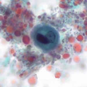 Ehistdisp_cyst_tric7_KS.jpg Figure D: Immature cyst of <em>E. histolytica/E. dispar</em> stained with trichrome. The cyst has large vacuoles and the chromatin around the nucleus is clumpy. These cysts range in size from 10.3 to 15.7 µm. Image taken at 1000x oil magnification and contributed by the Kansas Department of Health and Environment.