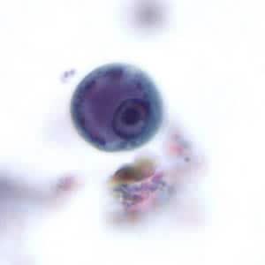Ehisto_cyst_tric.jpg Figure A: Immature cyst of <em>E. histolytica</em>. The specimen was preserved in poly-vinyl alcohol (PVA) and stained with trichrome. PCR was performed on this specimen to differentiate between <em>E. histolytica</em> and <em>E. dispar</em>