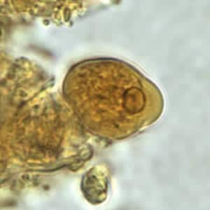 Ehistdisp_troph_wtmt.jpg Figure A: Trophozoite of <em>E. histolytica/E. dispar</em> in a direct wet mount stained with iodine.