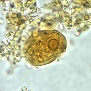 Ehistdisp_troph_wtmt2.jpg Figure B: Trophozoite of <em>E. histolytica/E. dispar</em> in a direct wet mount stained with iodine.