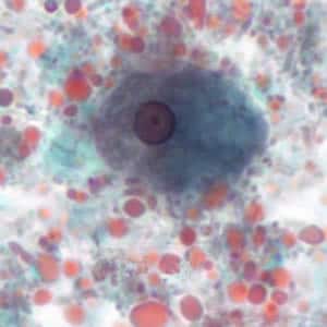 Ehistdisp_troph_tric3_KS.jpg Figure E: Trophozoite of <em>E. histolytica/E. dispar</em>, measuring approximately 16.7 µm, stained with trichrome. The image was taken at 1000× magnification and contributed by the Kansas Department of Health and Environment.