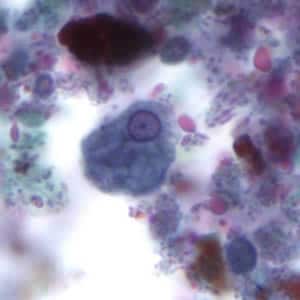 Ehisto_troph_tric.jpg Figure C: Trophozoite of <em>E. histolytica</em>. The specimen was preserved in poly-vinyl alcohol (PVA) and stained with trichrome. PCR was performed on this specimen to differentiate between <em>E. histolytica</em> and <em>E. dispar</em>.
