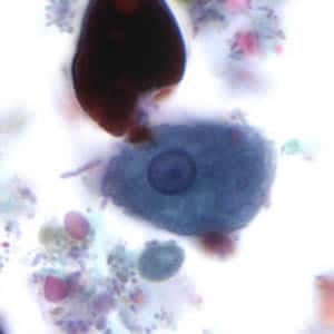 Ehisto_troph_tric2.jpg Figure D: Trophozoite of <em>E. histolytica</em>. The specimen was preserved in poly-vinyl alcohol (PVA) and stained with trichrome. The vacuolated cytoplasm seen in this image may be the result of less than optimal preservation. PCR was performed on this specimen to differentiate between <em>E. histolytica</em> and <em>E. dispar</em>.