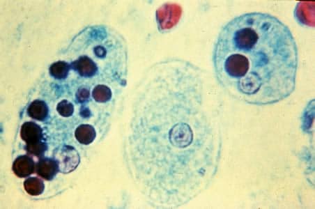 Ehisto_troph_tric4.jpg Figure B: Trophozoites of <em>E. histolytica</em> with ingested erythrocytes stained with trichrome. The ingested erythrocytes appear as dark inclusions. The parasites above show nuclei that have the typical small, centrally located karyosome, and thin, uniform peripheral chromatin.