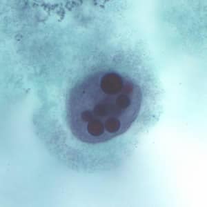 Ehisto_troph_tric5.jpg Figure C: Trophozoite of <em>E. histolytica</em> with ingested erythrocytes stained with trichrome.