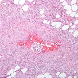 A_costaricensis_MN_A.jpg Figure A: <em>Angiostrongylus costaricensis</em> female worm in appendix tissue sections stained with hematoxylin and eosin (H&E). Image courtesy of Regions Hospital, St. Paul, MN.