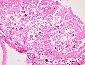 A_cost_B Figure B: Thin-shelled <em>A. costaricensis</em> eggs in intestinal tissue stained with H&E from the same specimen as Figure A, higher magnification. Note the varying stages of larval development.