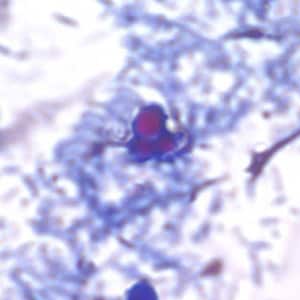 Figure B: Yeast in an acid-fast stained stool specimen. These may be confused for the oocysts of <em>Cryptosporidium</em> sp. Images courtesy of the Arizona State Public Health Laboratory.