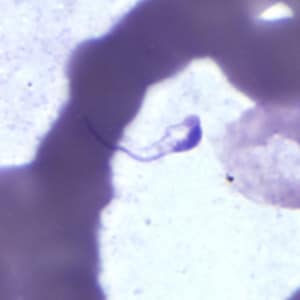 Figure A: Platelet in a thick blood smear. The nature of the platelet gives it the appearance of a trypomastigote of <em>Trypanosoma</em> sp.